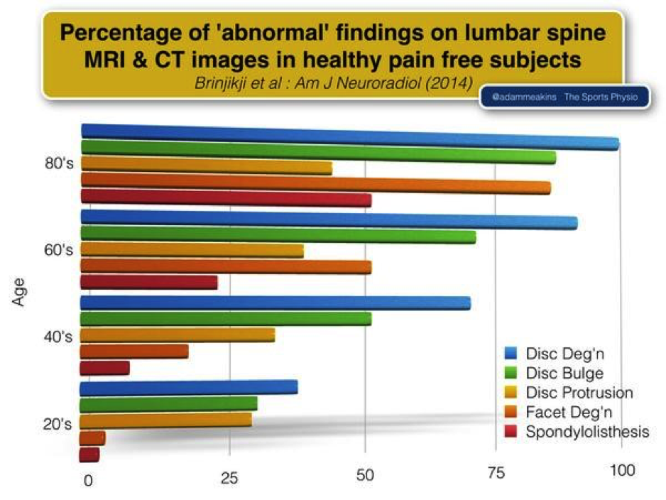 BG chart 1 Debunking 5 Myths on Disc Herniation