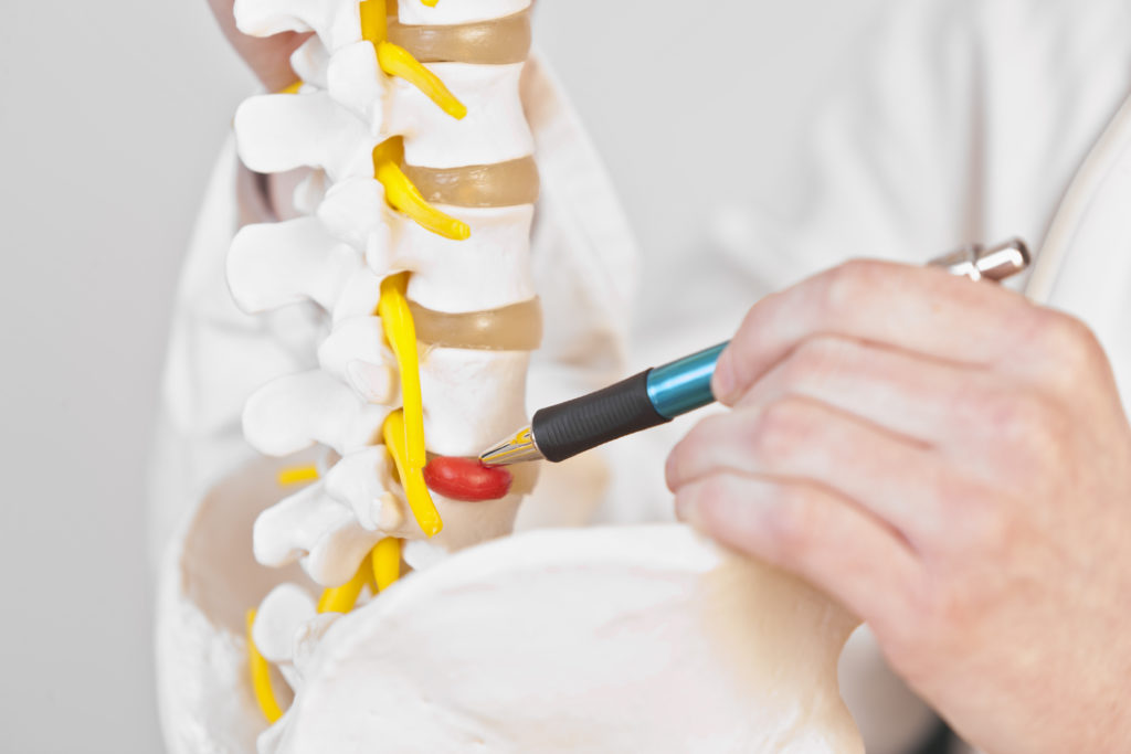 Debunking 5 Myths on Disc Herniation Body Gears Physical Therapy