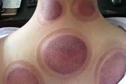 cupping1 What Are All Those Red Circular Marks at the Rio Games 2016?