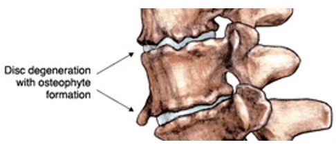 3 of The Leading Causes of Lower Back Pain & Sciatica Back Image 2 3 of The Leading Causes of Lower Back Pain & Sciatica